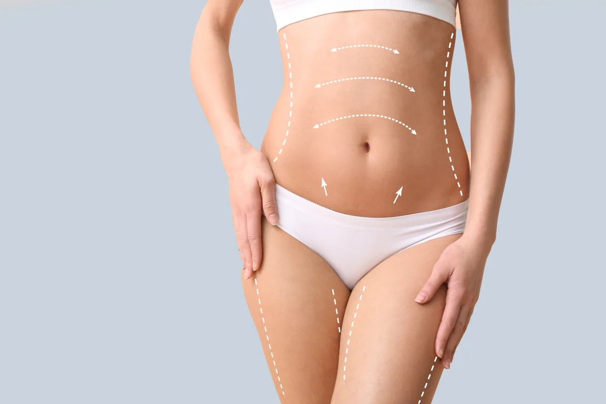 Fettabsaugung Facetite - Bodytite und Acutite Fettabsaugung Facetite - Bodytite und Acutite